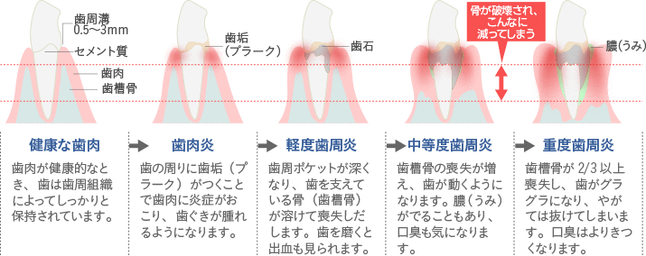 歯周病の進行