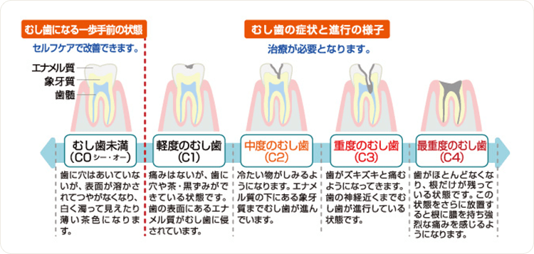 むし歯の症状と進行の様子